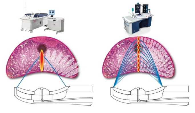 Traitement du cancer de la prostate par HIFU : de l'Ablatherm au Focal One